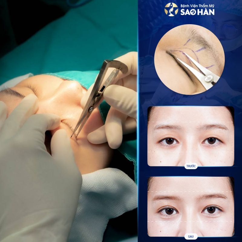 Phẫu thuật mắt 2 mí tại Bệnh viện Thẩm mỹ Sao Hàn