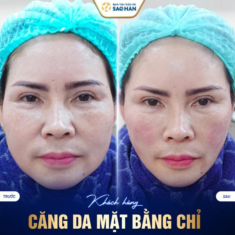 Dịch vụ căng bóng da Hàn Quốc tại bệnh viện Sao Hàn