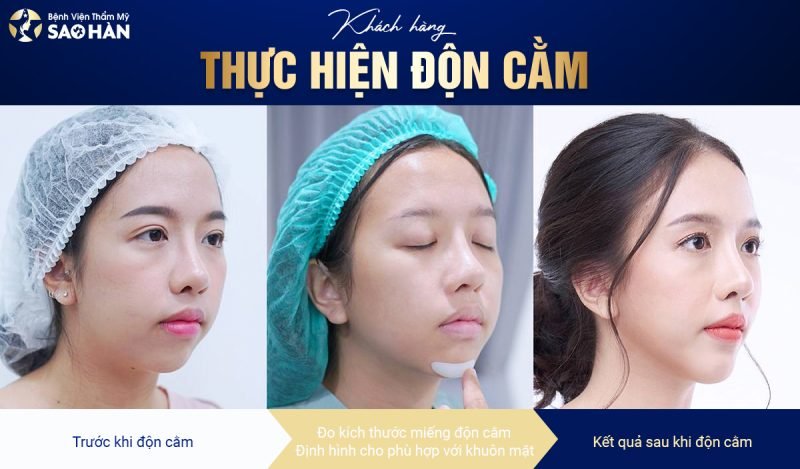 Chỉnh cằm lẹm tại Bệnh viện thẩm mỹ Sao Hàn