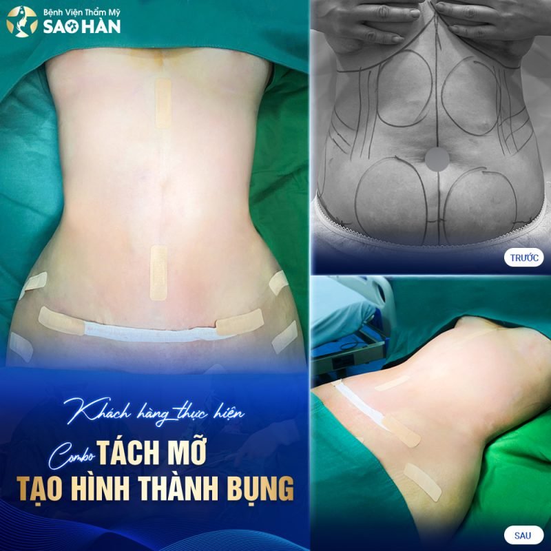 Dịch vụ ép mỡ bụng tại Bệnh viện Sao Hàn