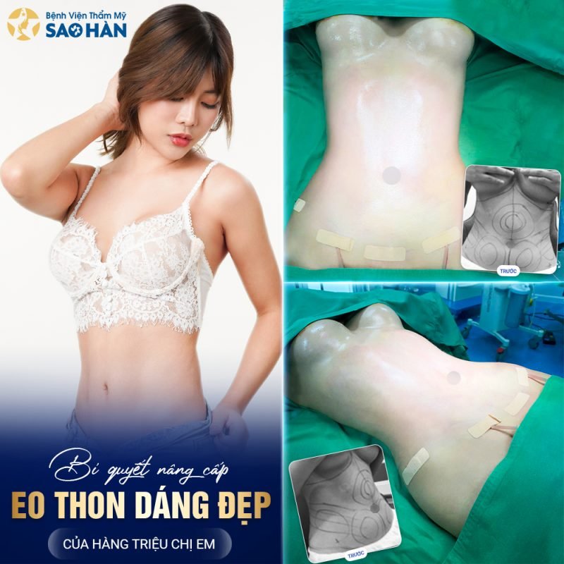 Tạo Hình Body S-Line Tại Bệnh Viện Sao Hàn