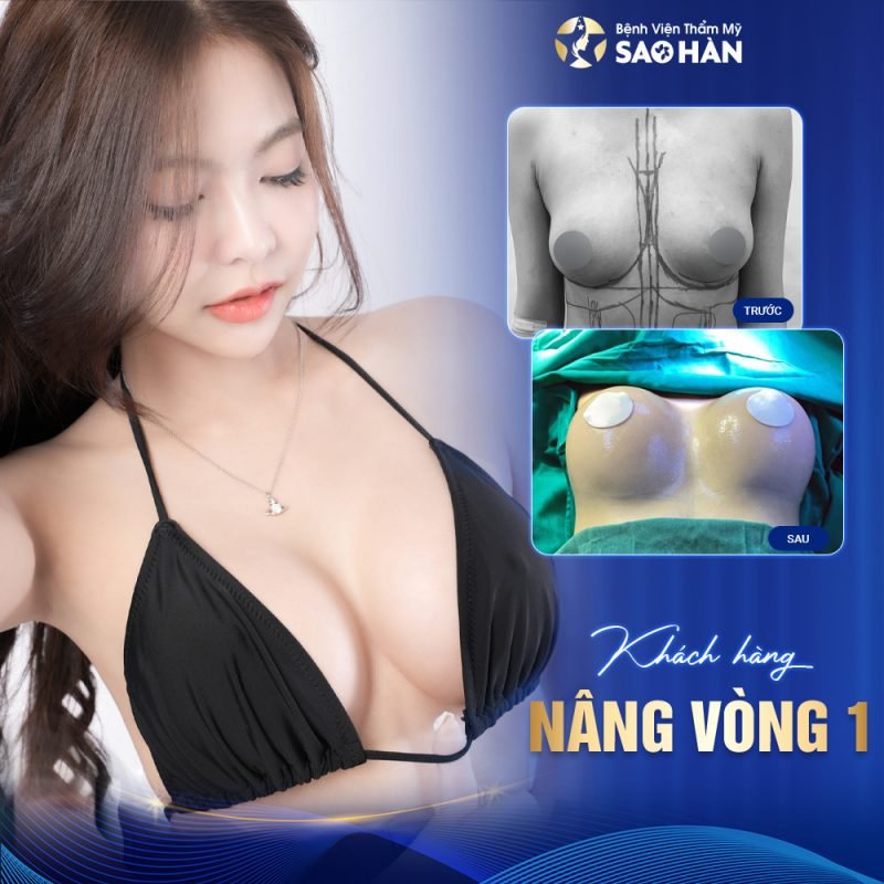 Dịch vụ tái tạo ngực sau sinh tại Bệnh viện Sao Hàn