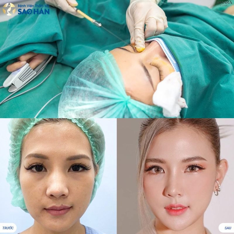 Tiêm botox xoá nhăn trán tại bệnh viện Sao Hàn