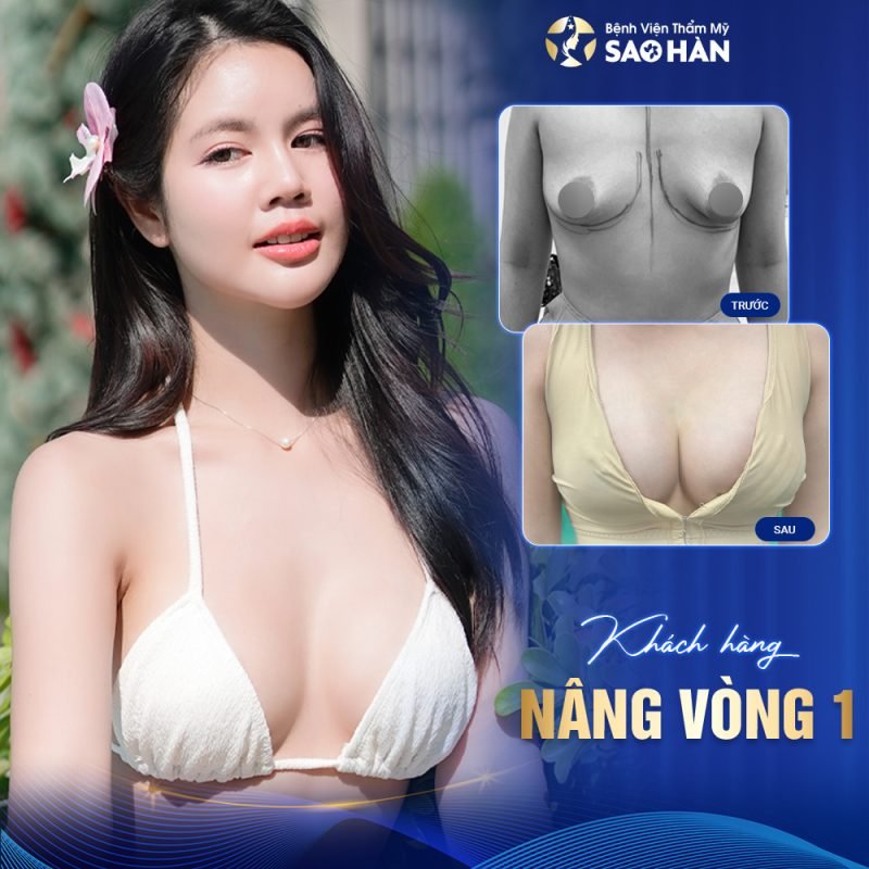 Nâng Ngực An Toàn Tại Bệnh Viện Sao Hàn